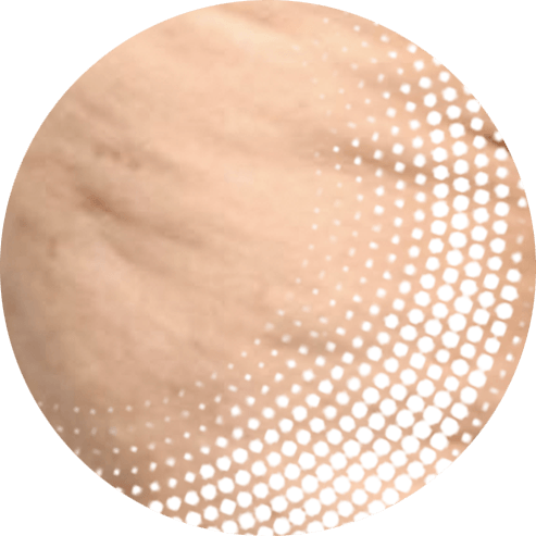 Cellulite